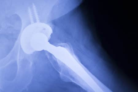 DePuy Hip Implant Class Action Lawsuit