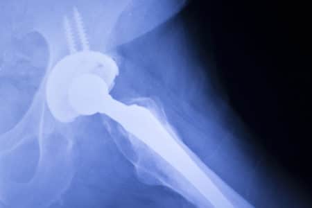 Stryker LFIT V40 Hip Implant Class Action Lawsuit