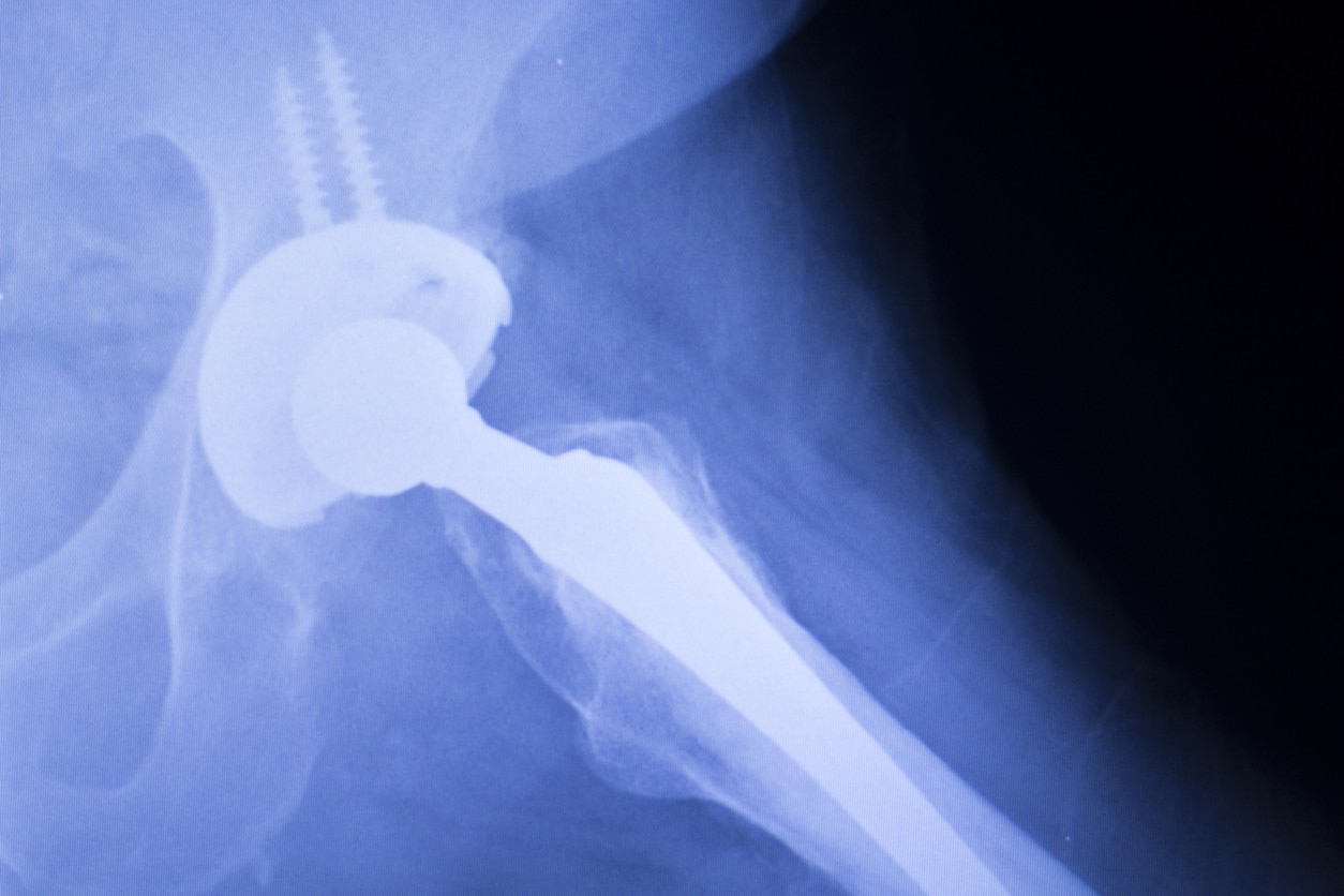 Zimmer Ordered to Pay 2 Million for Hip Replacement Complications