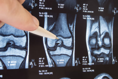 Knee Implant X-ray