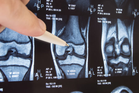 Knee Implant X-ray
