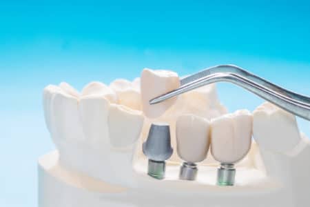 Dental Implants Class Action Lawsuit